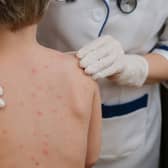 Chickenpox is a viral infection that mostly affects children, although you can get it at any age