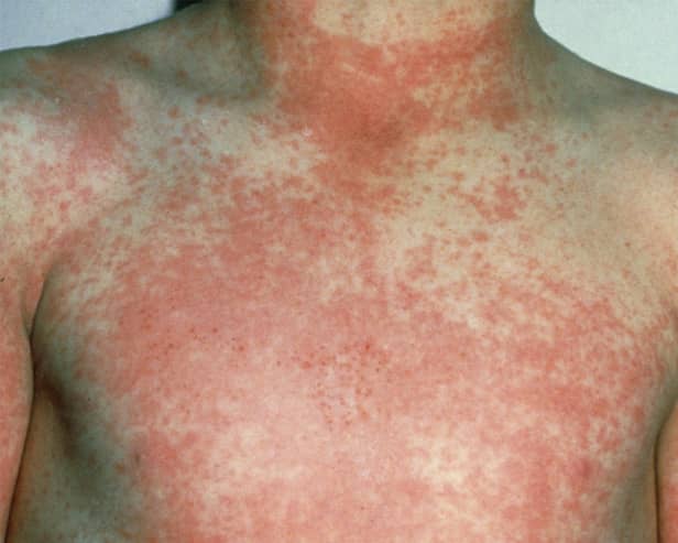 After 12 to 48 hours the characteristic fine red rash of scarlet fever develops