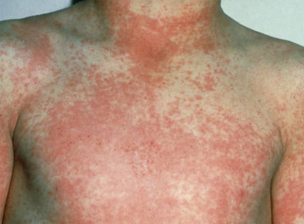After 12 to 48 hours the characteristic fine red rash of scarlet fever develops
