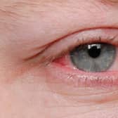 A new Covid variant, which has been found to be more infectious, is said to have an added rare symptom of conjunctivitis or pinkeye. 