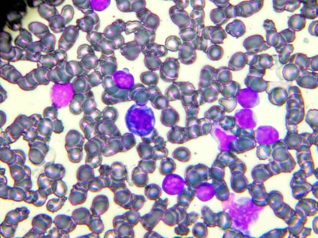 New treatment for children and adults with leukaemia (photo: Getty Images/iStockphoto)
