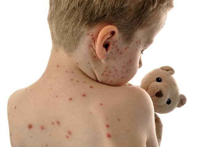 Measles causes a red blotchy rash to spread across the body (Photo: Adobe)