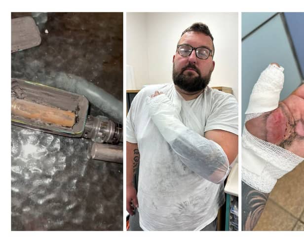 A lorry driver suffered horror injuries when an e-cigarette exploded in his hand.
Mike Calver, 38, was changing the battery on his device at home in Stoke-on-Trent, when it blew up.
His hand, beard and clothes were set on fire - while the scalding e-cigarette stuck to his hand.