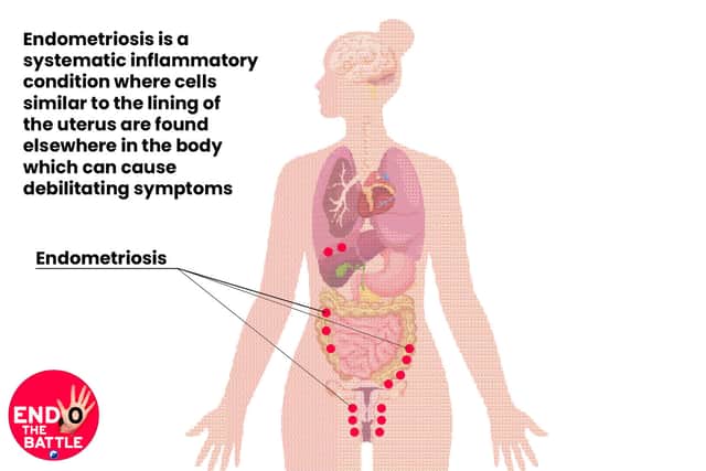 Endometriosis can cause debilitating symptoms