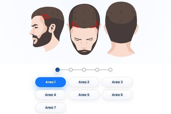 A graft calculator for a hair transplantTurkey patient under Dr Busra Yakupoglu . 