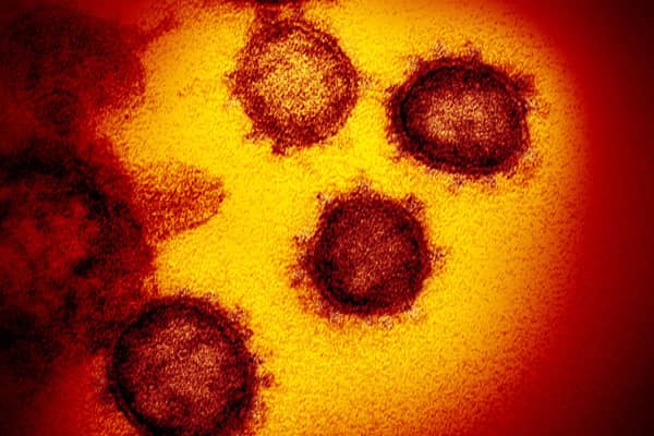 This undated electron microscope image made available by the U.S. National Institutes of Health in February 2020 shows the Novel Coronavirus SARS-CoV-2. Also known as 2019-nCoV, the virus causes COVID-19. The sample was isolated from a patient in the U.S. (NIAID-RML via AP)