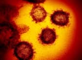 This undated electron microscope image made available by the U.S. National Institutes of Health in February 2020 shows the Novel Coronavirus SARS-CoV-2. Also known as 2019-nCoV, the virus causes COVID-19. The sample was isolated from a patient in the U.S. (NIAID-RML via AP)