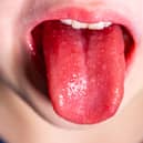 Tongue of a child with scarlet fever - strawberry tongue.