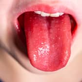 Tongue of a child with scarlet fever - strawberry tongue.