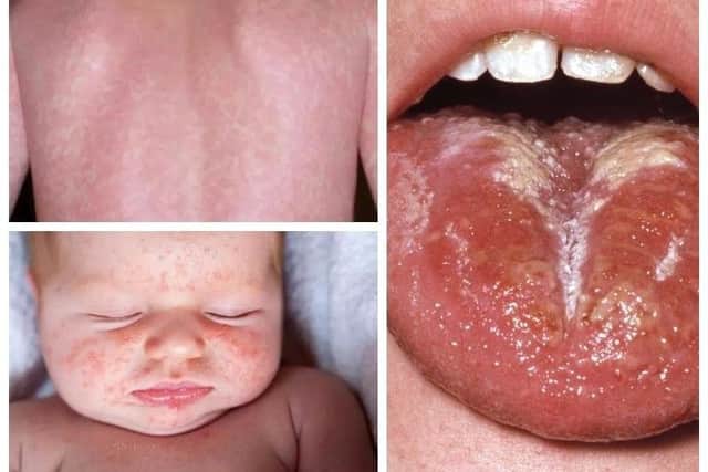 Scarlet Fever symptoms. Photo: NHS. Sheffield’s director of public health has warned that the city is seeing a rise in the contagious infection which was common in Victorian times
