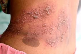 Shingles vaccine helps reduce the risk of it developing and, if it does, reduces how serious the symptoms will be.