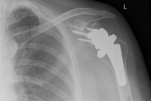Anne has greater movement in her arm thanks to shoulder replacement surgery.