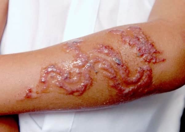 James Wilson (6) whose arms have blistered badly after having Henna tattoos done whilst on holiday