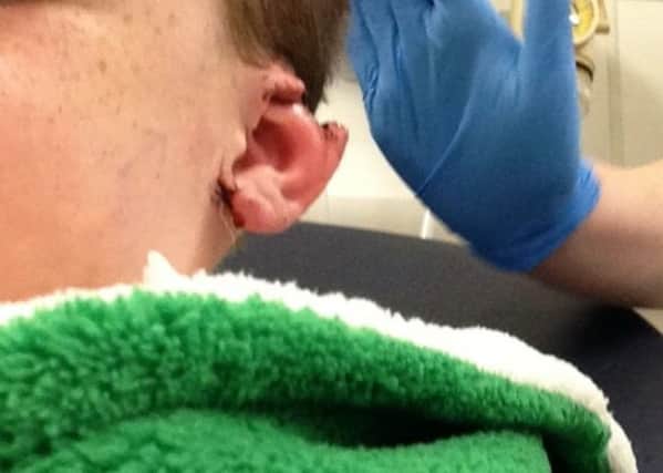 Ryan Booth was attacked by a dog and lost part of his ear.